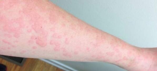 Кожните алергии са признак за наличие на паразити в организма